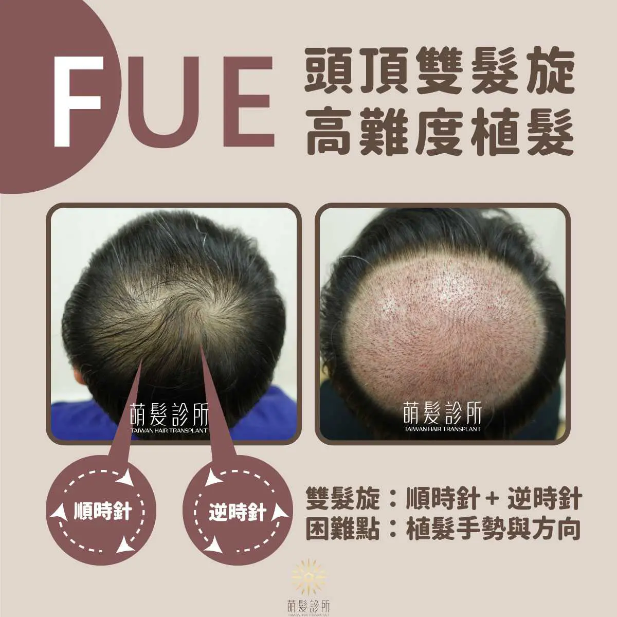 雙髮旋植髮與髮旋禿評估 4