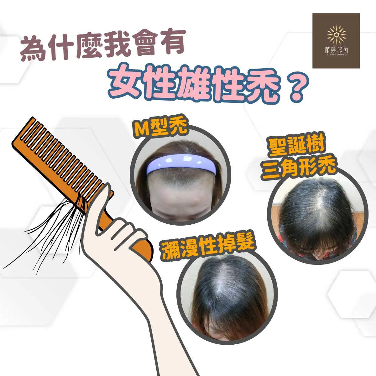 女性雄性禿M型禿三角禿評估