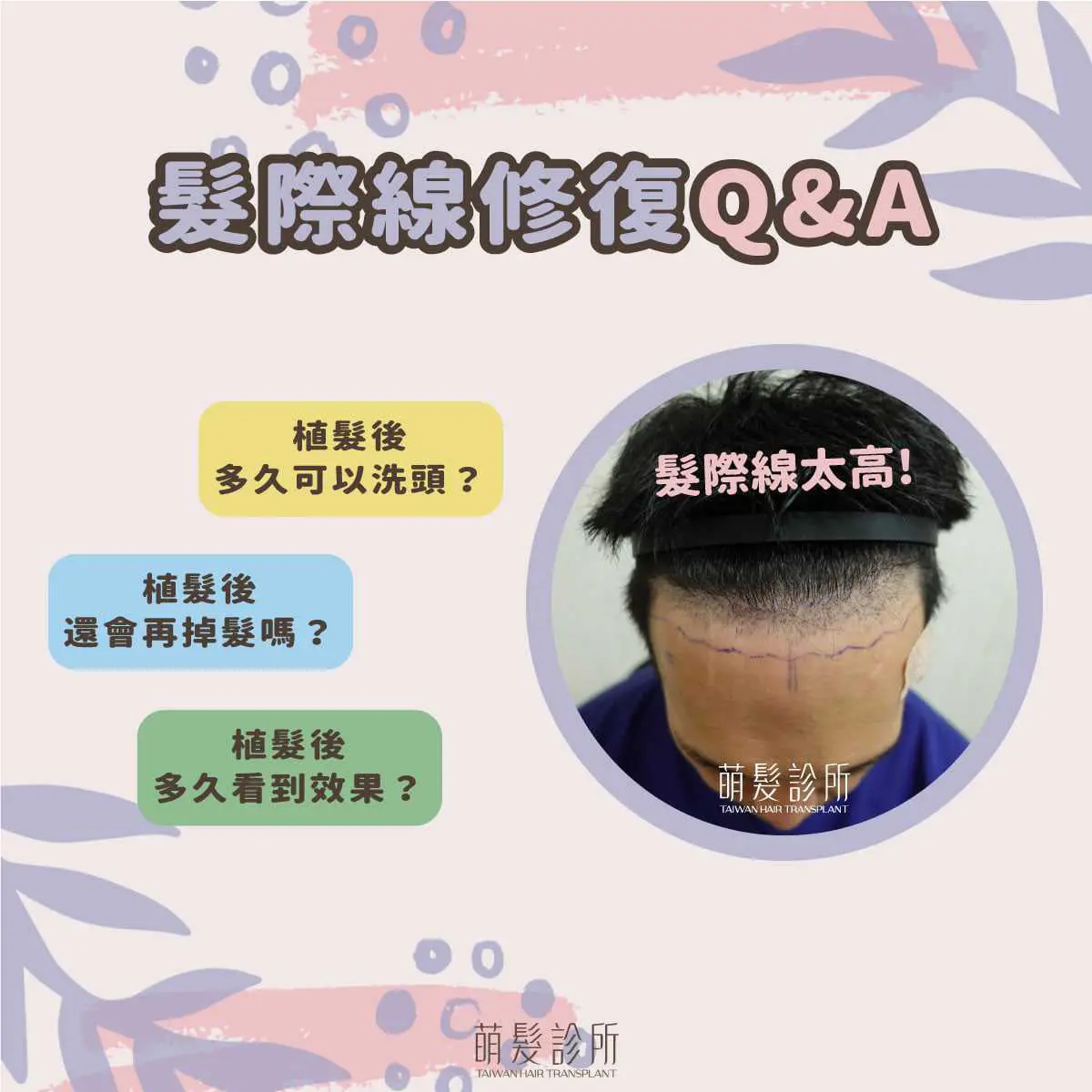 男性髮際線植髮設計株數術式與恢復評估