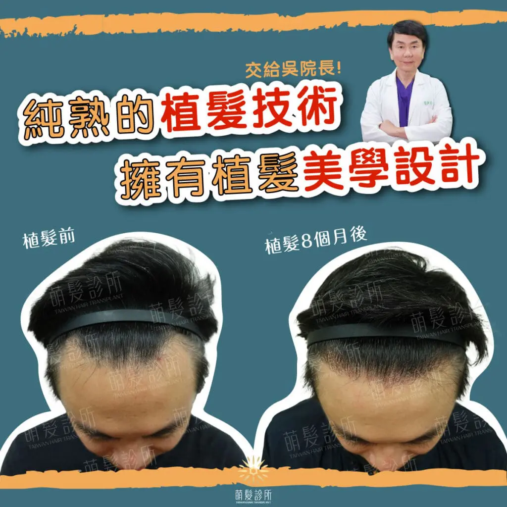 植髮改善M型空洞，8個月恢復漂亮髮際線