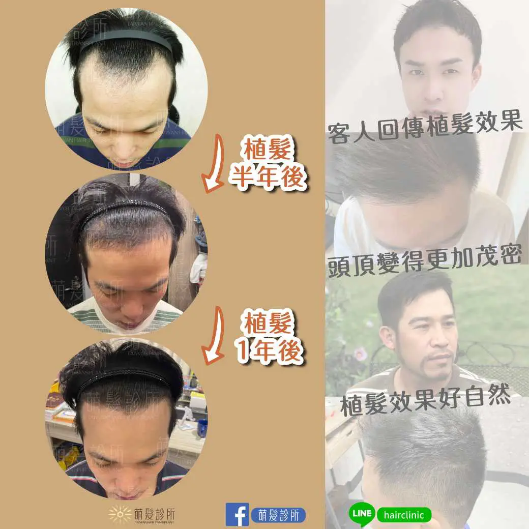 植髮後生長時間與一年恢復週期