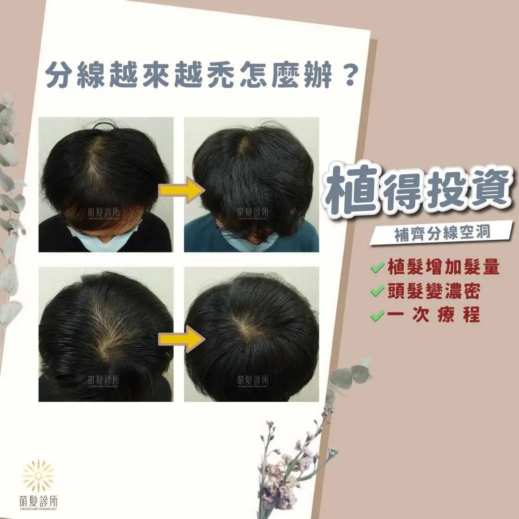 頭頂分線變寬與男女髮量稀疏評估 5
