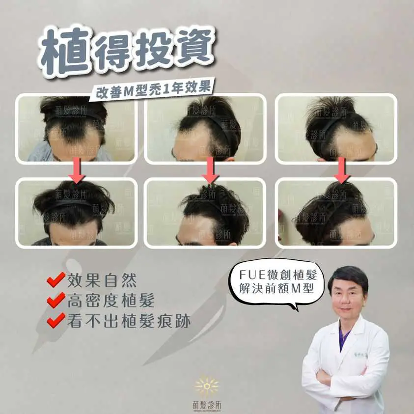 植髮手術不可怕，怕的是越來越後退的M型禿