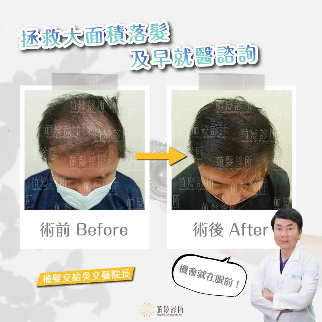 大面積雄性禿植髮供髮區與分期規劃 2