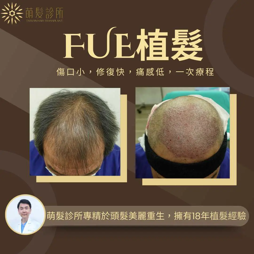 白髮植髮染髮取髮與供髮區評估 2