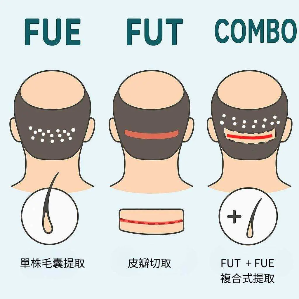 FUE植髮與其他植髮手術比較