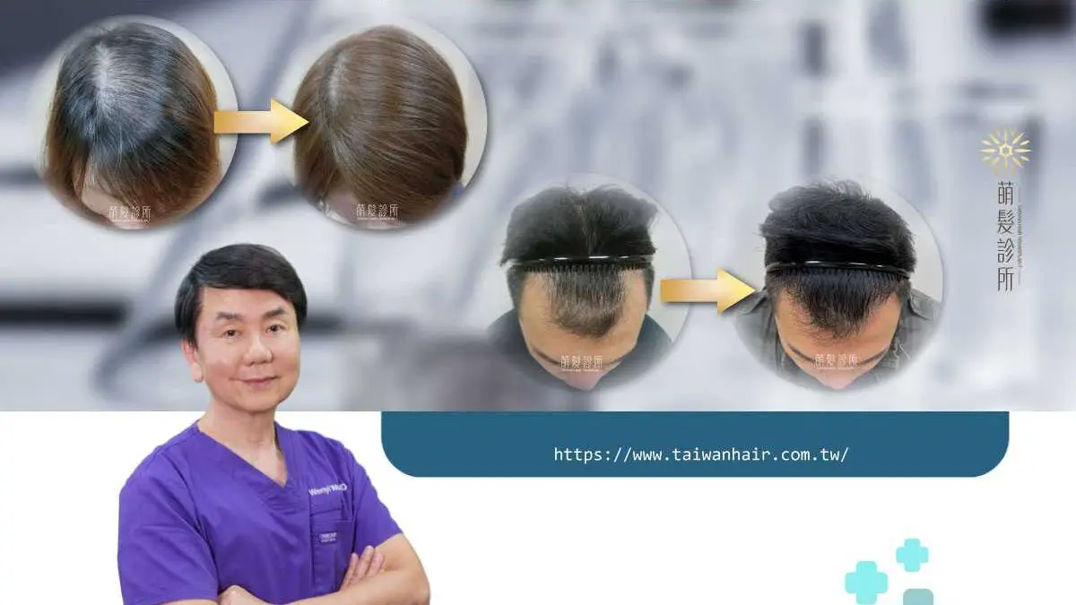 掉髮原因找不到嗎？該如何判斷是否有雄性禿？