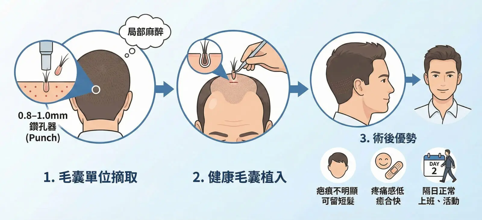 什麼是FUE微創植髮？