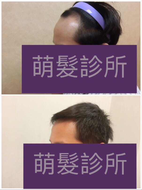 FUE植髮1800株 前額實例