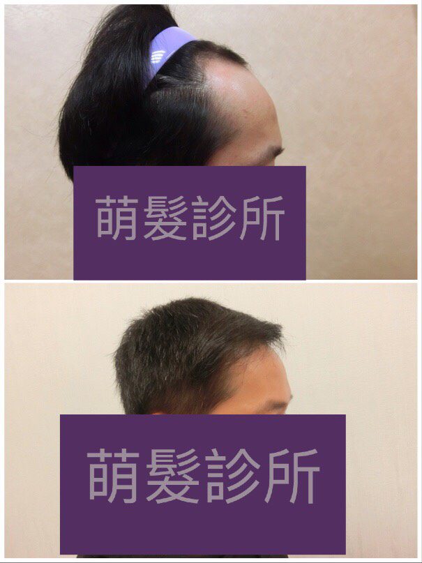 FUE植髮1800株 前額實例案例圖片 2