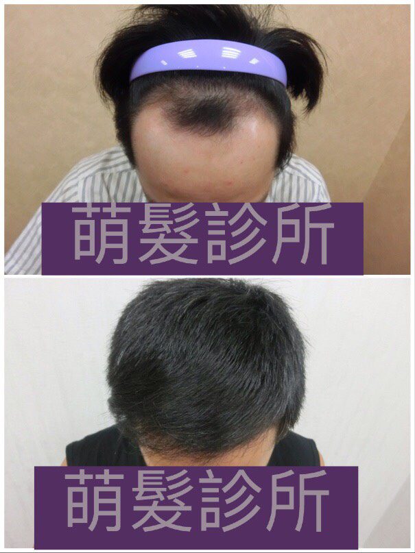 FUE植髮1800株 前額實例案例圖片 3