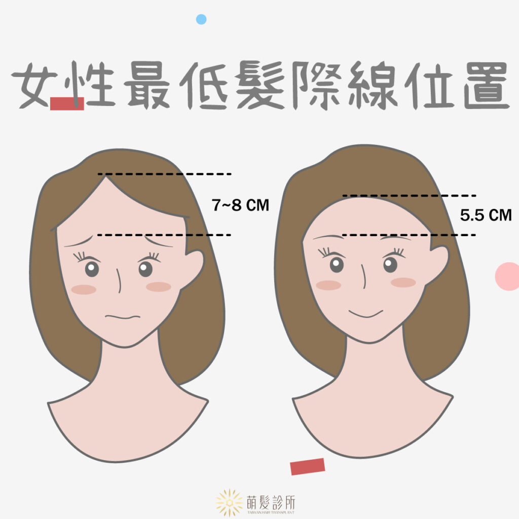 女性最低髮際線在哪裡？