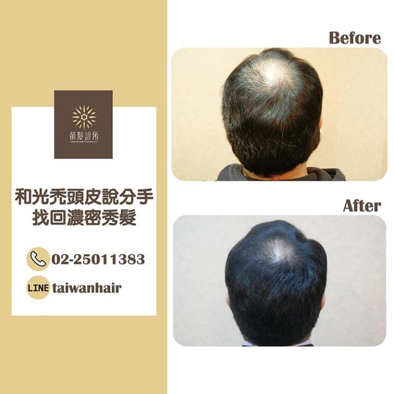 和光禿頭皮說分手，找回濃密秀髮 (FUT 3439株)