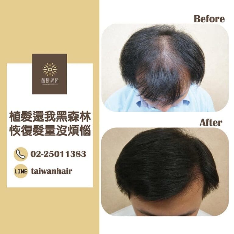 植髮還我黑森林，恢復髮量不煩惱 (FUT 2513株)