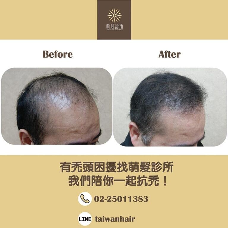 有禿頭困擾找萌髮診所，我們陪你一起抗禿！ (FUT 2866株)