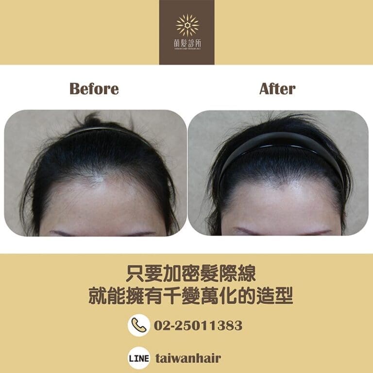 只要加密髮際線，就能擁有千變萬化的造型 (FUT 2051株)