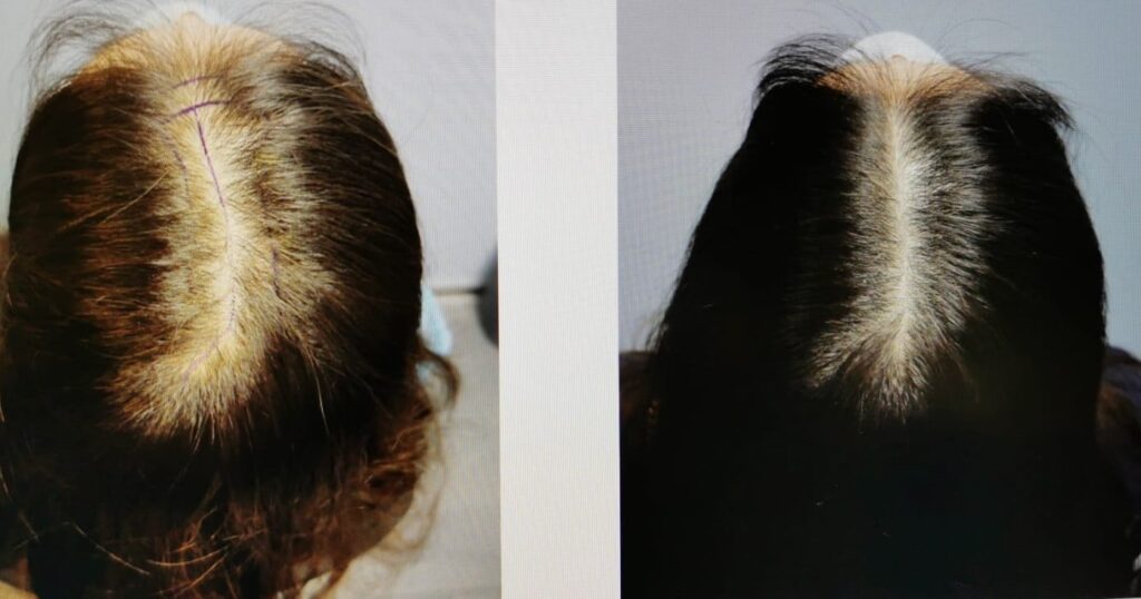 醫學紋髮scalp micropigmentation