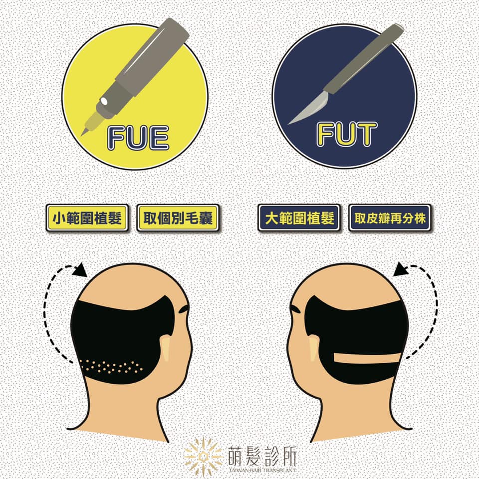 1分鐘搞懂 FUT與 FUE 目前有兩個不同的植髮方式