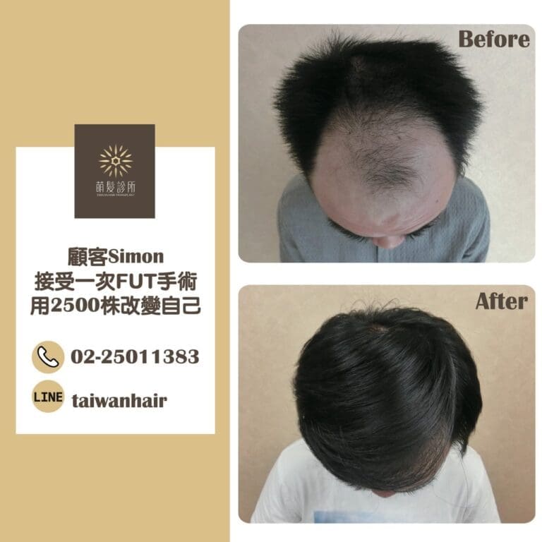 客人實例 FUT手術2500株