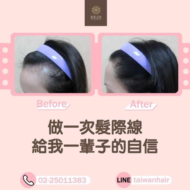 做一次髮際線,綁起馬尾更有自信！
