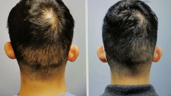 醫學紋髮scalp micropigmentation