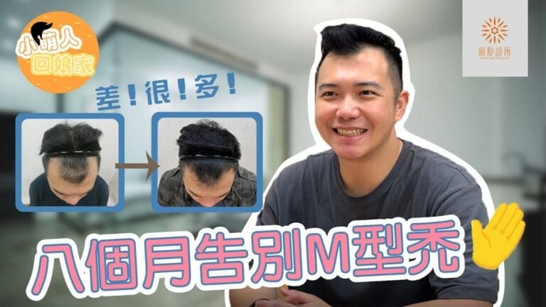 FUE植髮八個月告別M型禿｜張先生的真實轉變故事