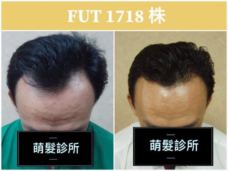 FUT植髮1718株 M型禿實例