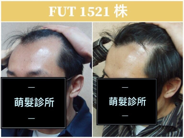 FUT植髮1521株 M型禿實例