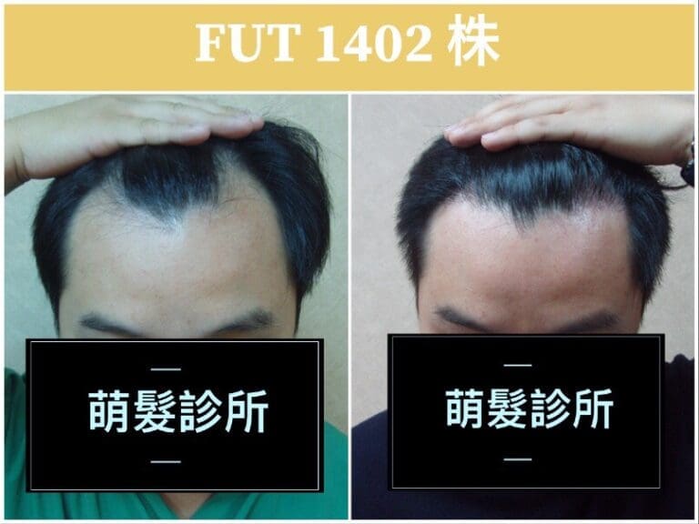 FUT植髮1402株 M型禿實例