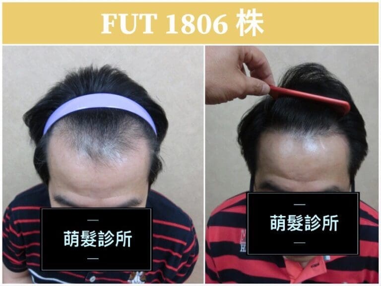 FUT植髮1806株 前額實例