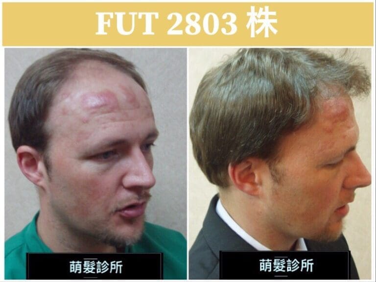 FUT植髮2803株 前額實例