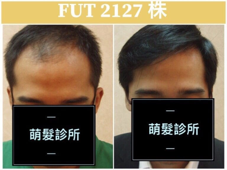 FUT植髮2127株 前額實例