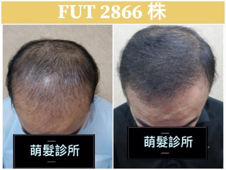 FUT植髮2866株 頭頂髮旋實例