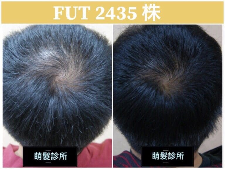 FUT植髮2435株 髮旋前額實例