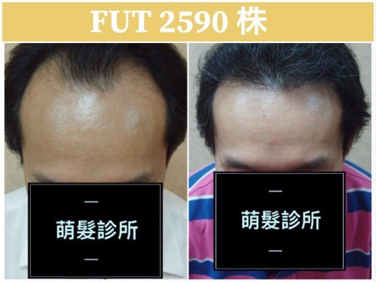 FUT植髮2590株 M型禿實例
