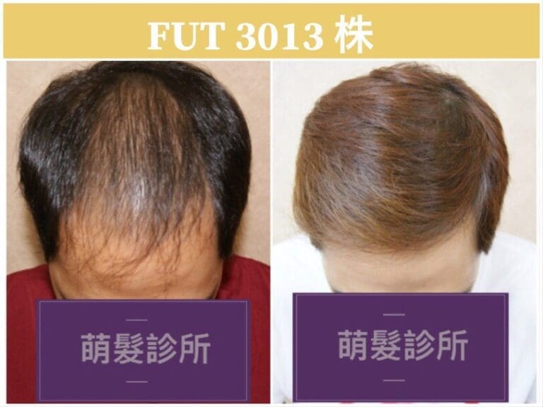 FUT植髮3013株 前額實例