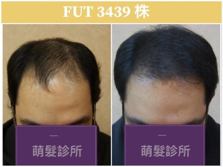 FUT植髮3439株 前額實例