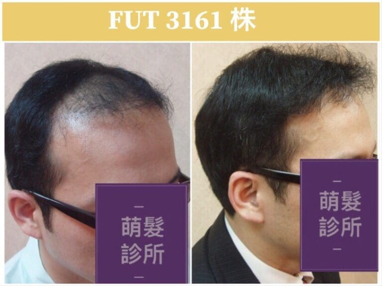FUT植髮3161株 前額實例