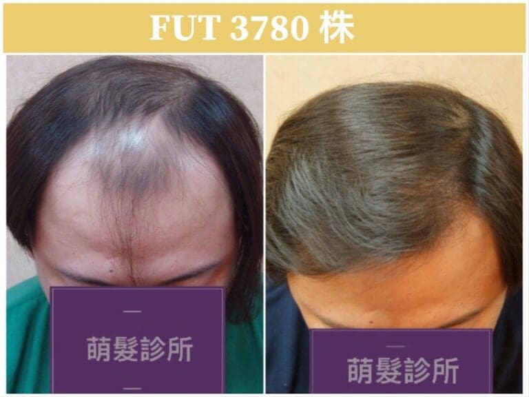 FUT植髮3780株 前額實例