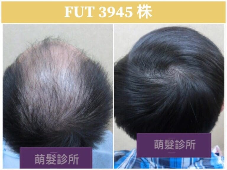 FUT植髮3945株 前額髮旋實例