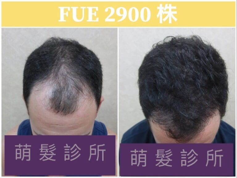 FUE植髮2900株 前額髮旋實例