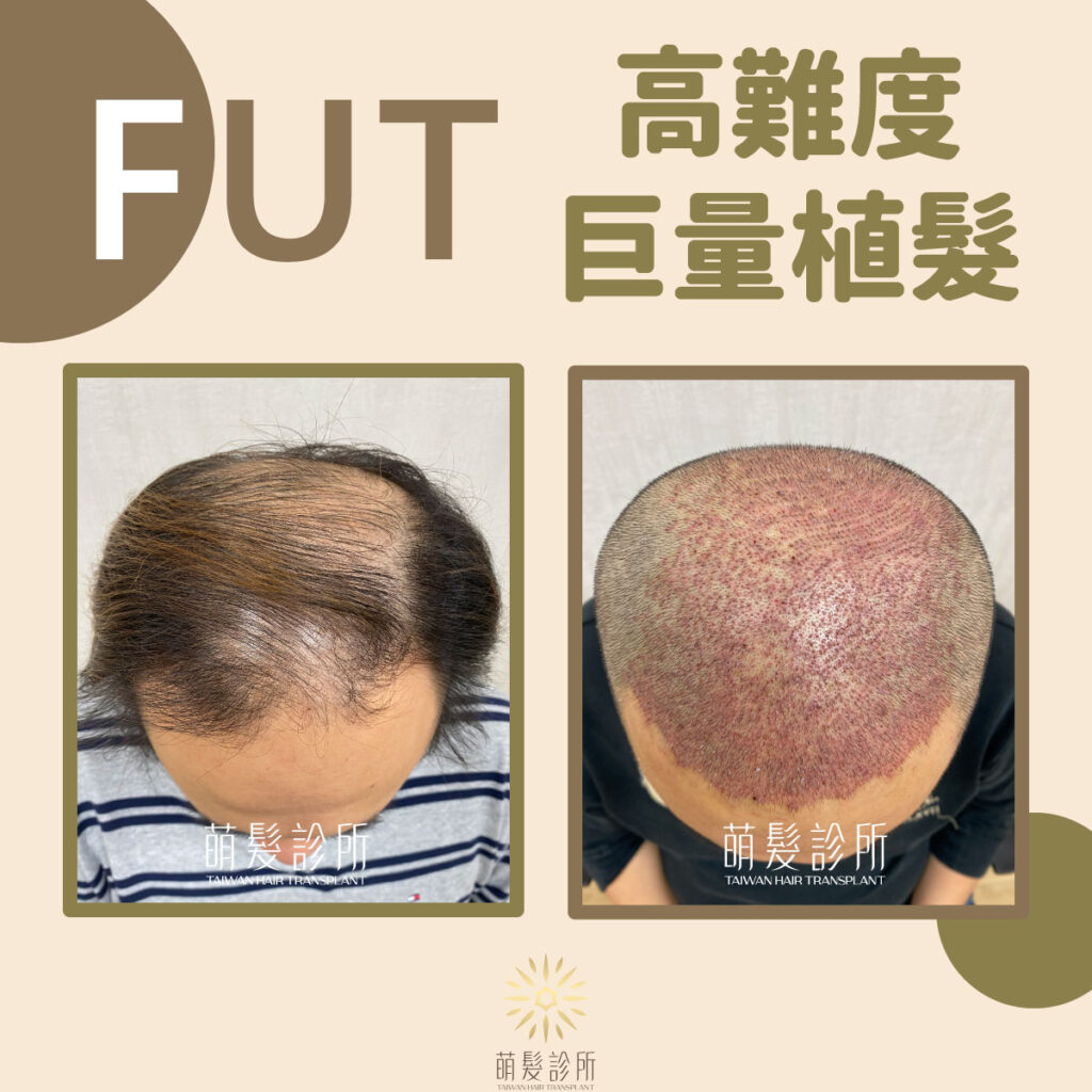 高難度FUT巨量植髮手術案例