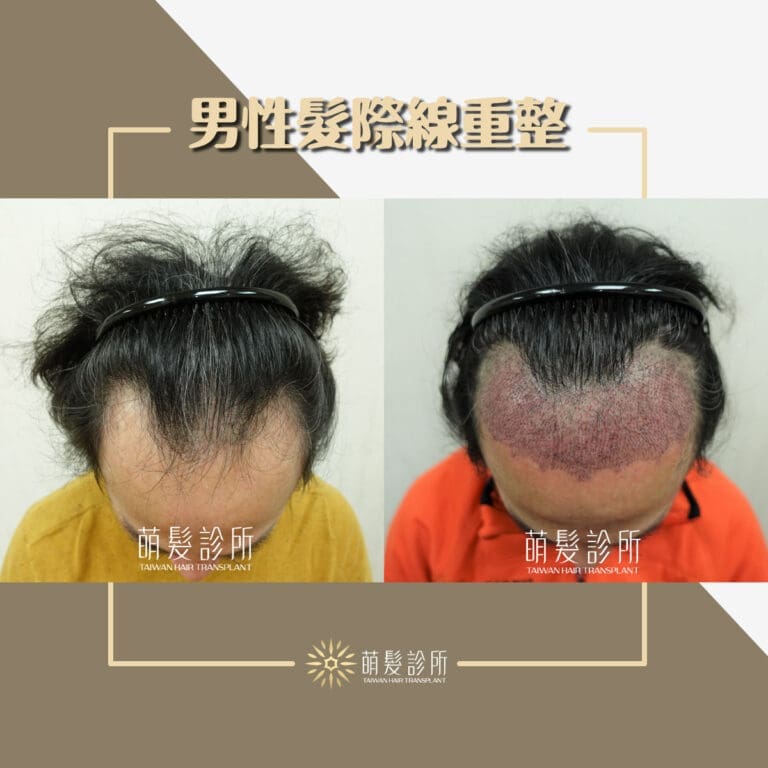 高密度男性髮際線重整