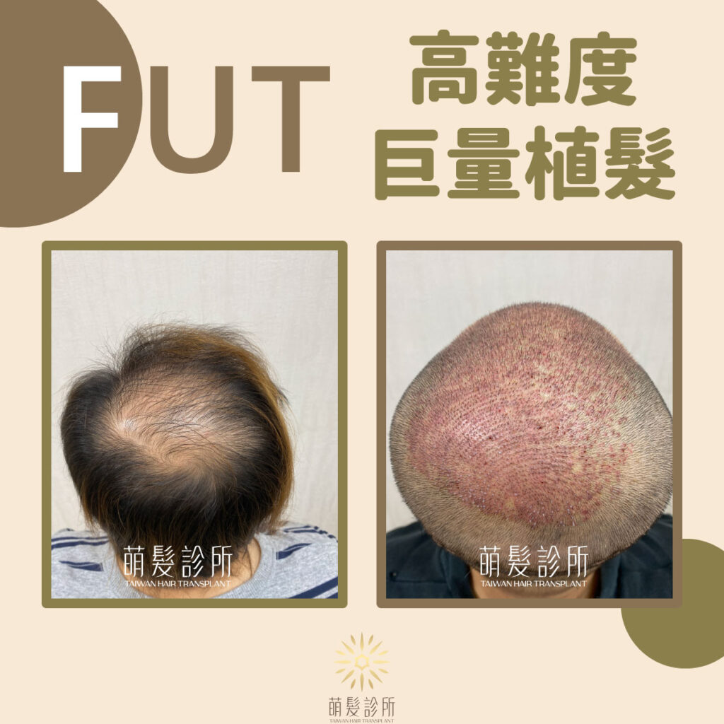 高難度FUT地中海禿植髮手術案例