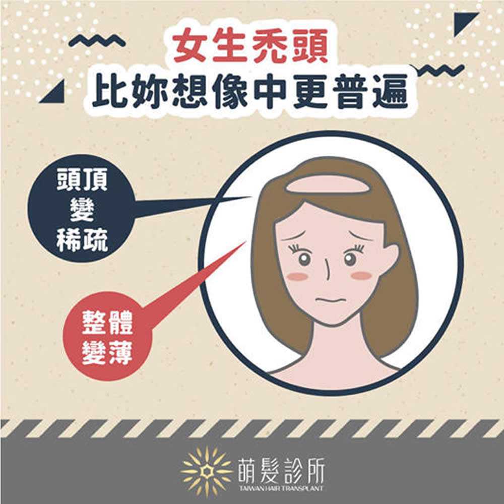 女生也會禿頭！為什麼會造成女性禿頭?