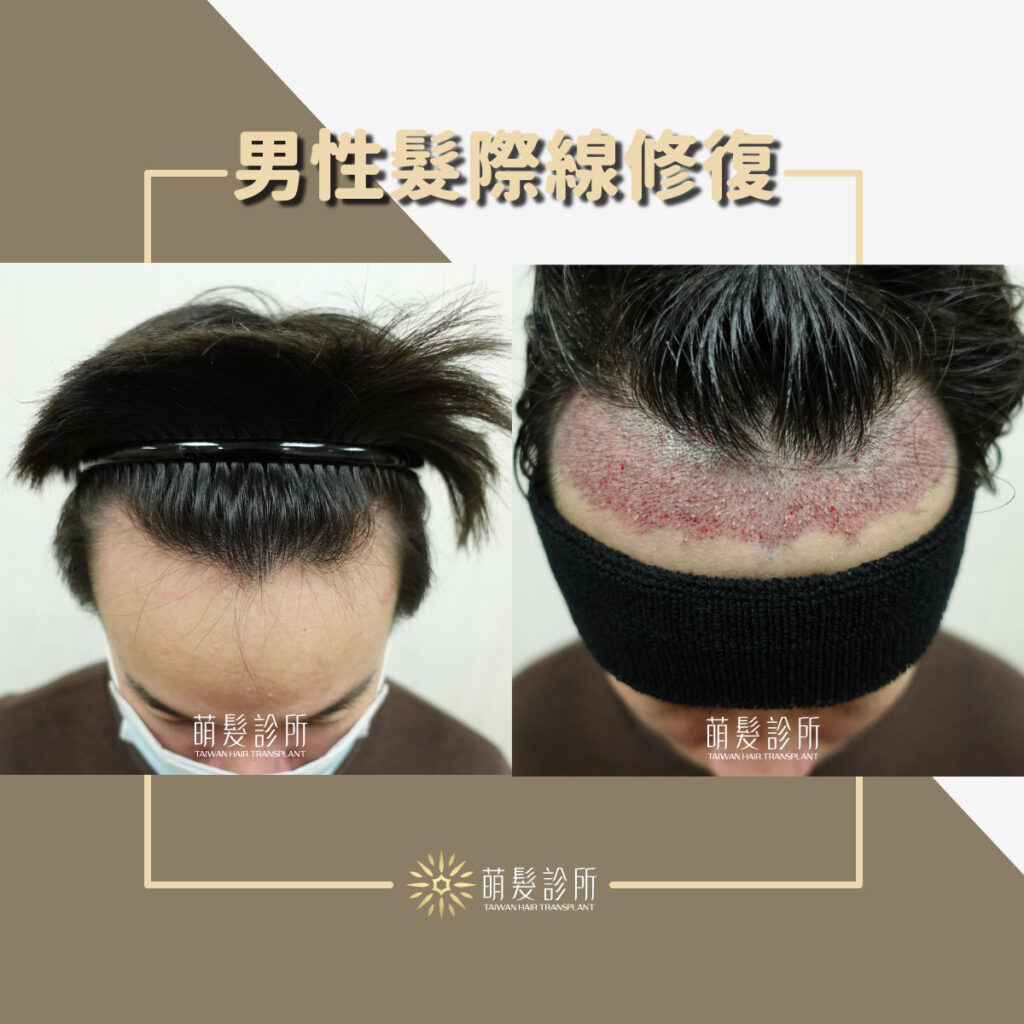 男性髮際線修復與加密度，解決光禿的額頭