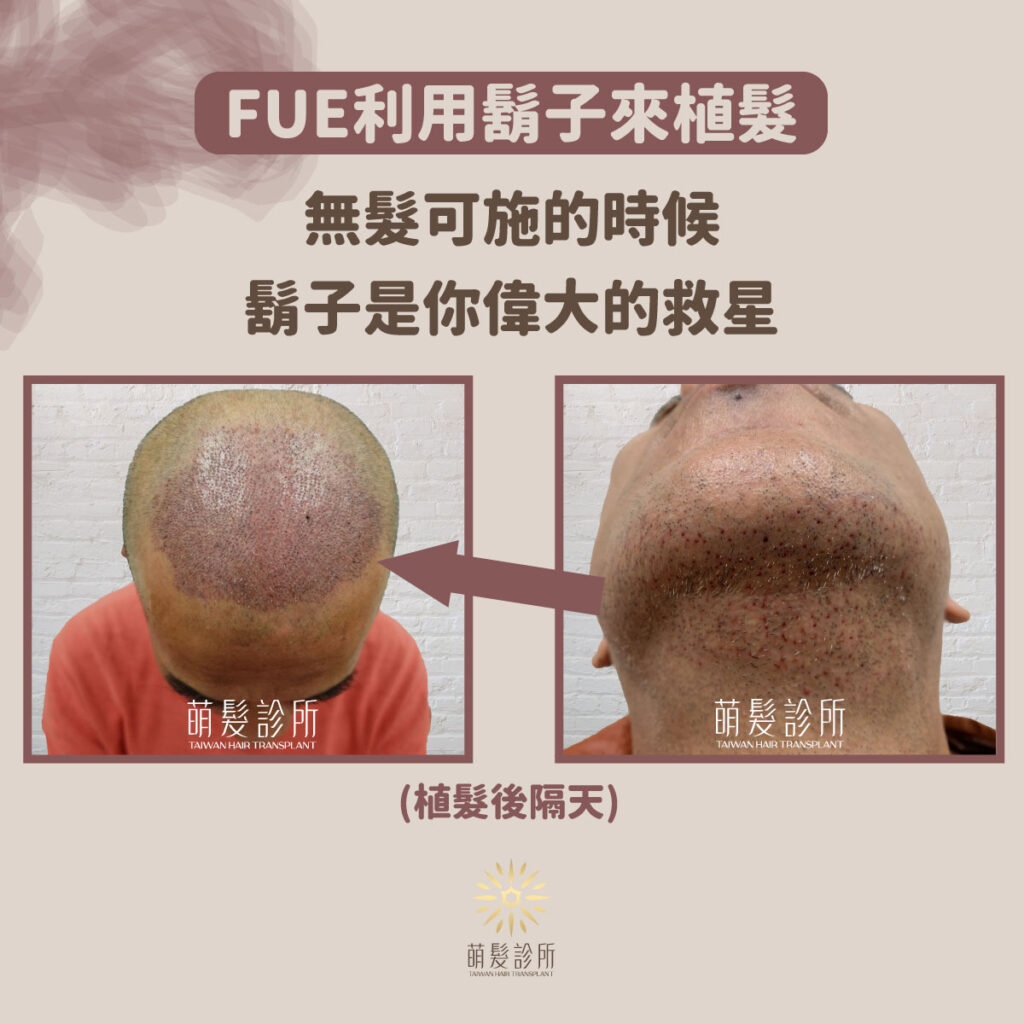 FUE利用鬍子也可以植髮哦