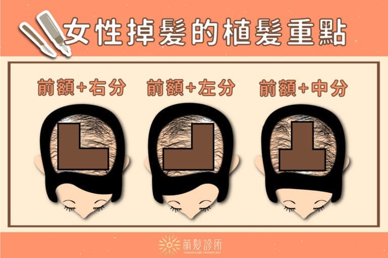 女性掉髮可以植髮嗎？