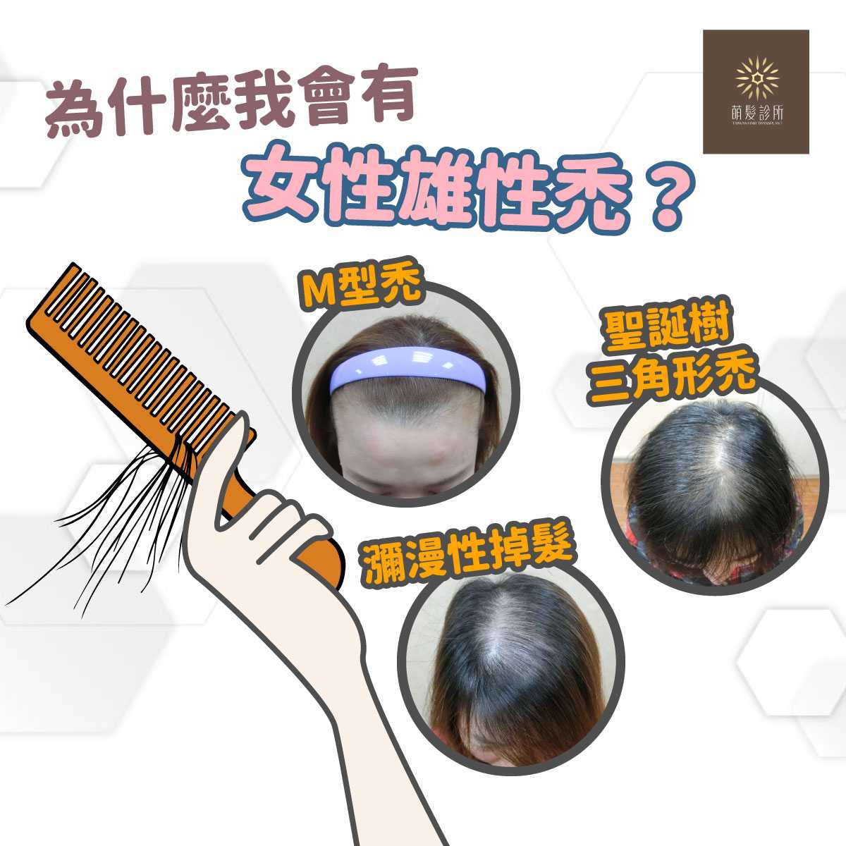 女性雄性禿M型禿三角禿評估