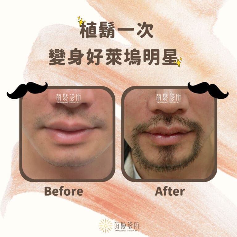 植鬍為您打造適合您的鬍子造型